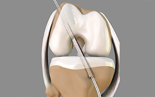 ACL Reconstruction