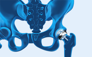 Hip Resurfacing
