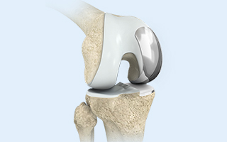 Partial Knee Replacement