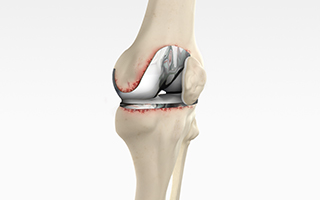 Revision Knee Replacement