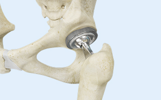 Hip Replacement